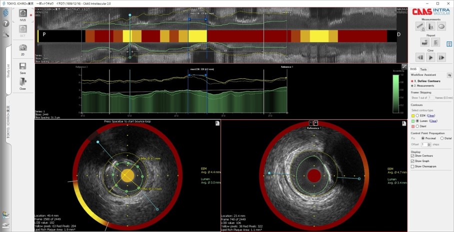 IVUS / OCT解析システム CAAS IntraVascular